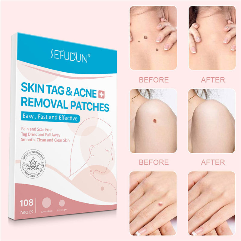 Natural Painless Auto Skin Tag Removal Kit Skin Tag Bands Remover Patches