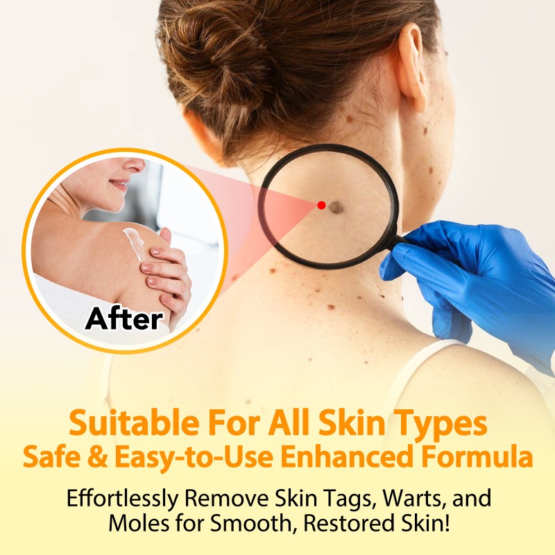 Bee Venom Cream Moles and Warts Removal Cream ﻿