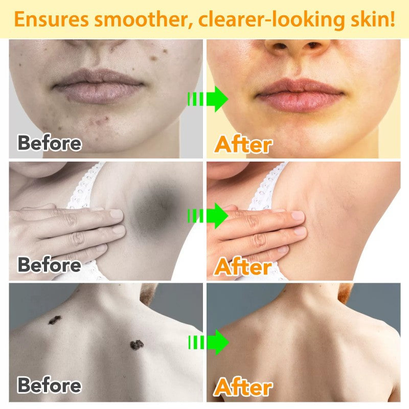 Bee Venom Cream Moles and Warts Removal Cream ﻿