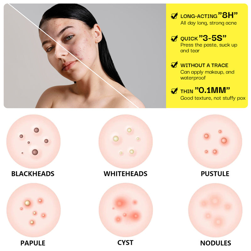 10Pcs/box Hydrocolloid Acne Patch Forehead And Cheeks Pimple Patches