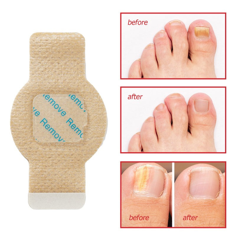 21Pcs Nail Treatment Repair Patch Toenail Pads
