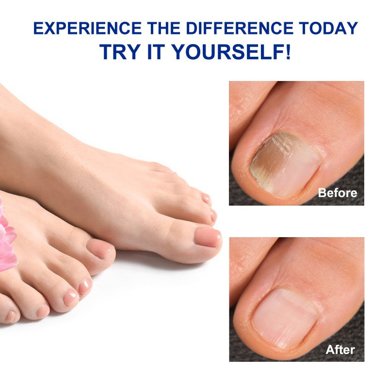 32 Pcs Nail Toenail Treatment Repair Patches Pads