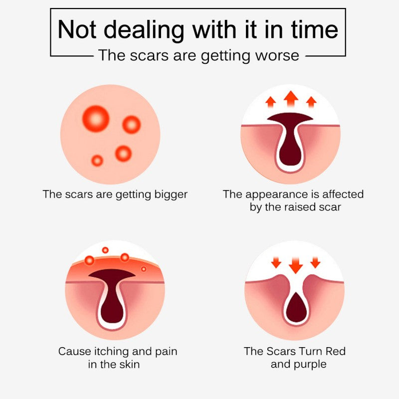 Scar Removal Cream New & Appearance of Old Scars Surgery, Stretch Marks, Acne
