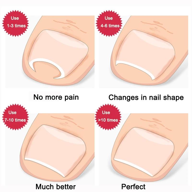 Ingrown Toenail Toe Fixer Recover Correction Device Pedicure Foot Nail ...