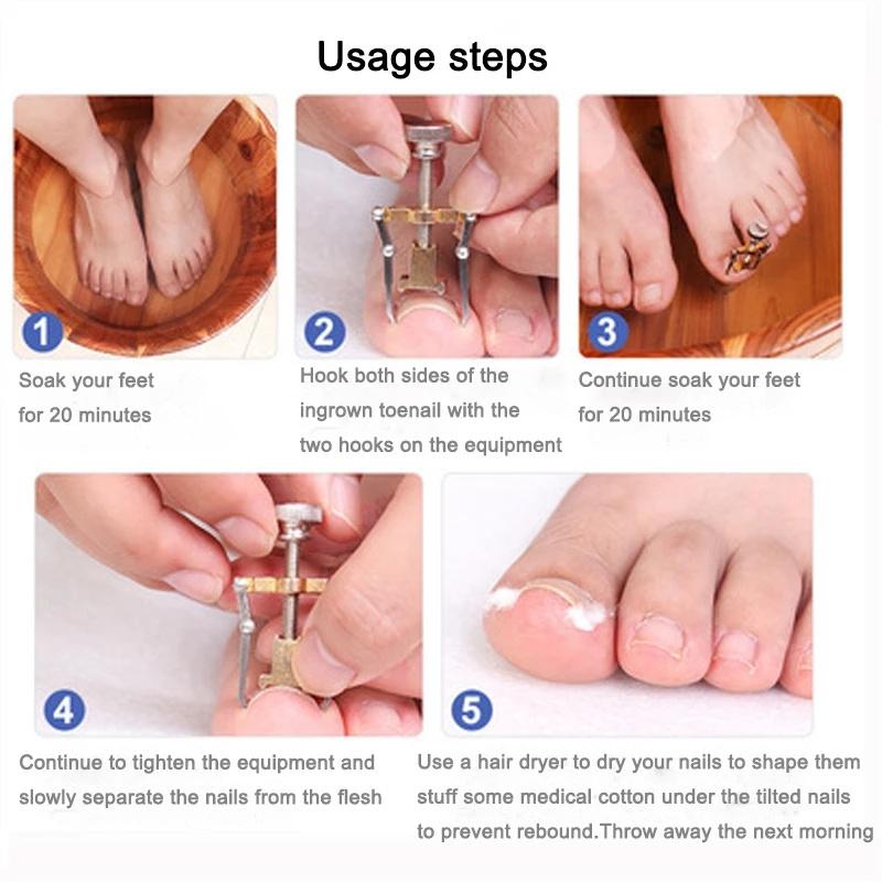 Ingrown Toenail Toe Fixer Recover Correction Device Pedicure Foot Nail ...