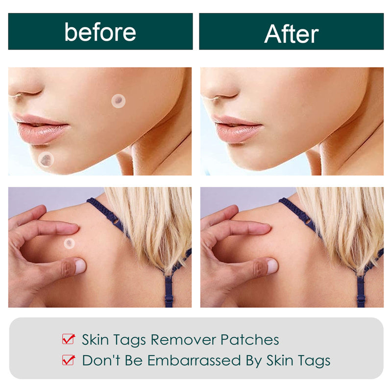 Skin Tag Removal Patches