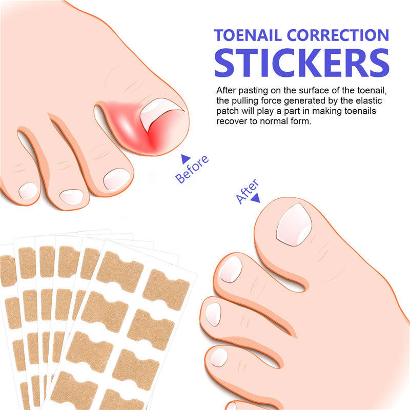 Ingrown Toenail Corrector Correction Patch Strips 100PCS
